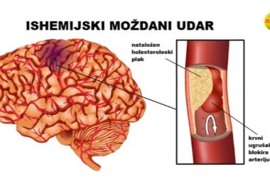 Може ли се мождани удар спречити