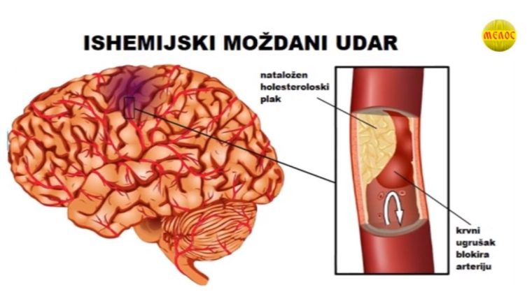Може ли се мождани удар спречити